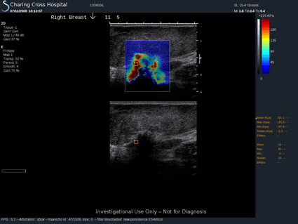 Image: Aixplorer elastography map, which shows the elasticity or stiffness in tissue by color (photo courtesy of SuperSonic Imagine).